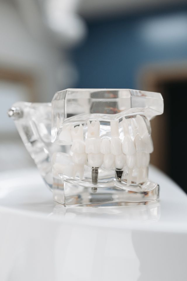 Implantes dentales